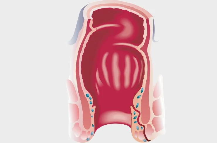 Anal Fistula