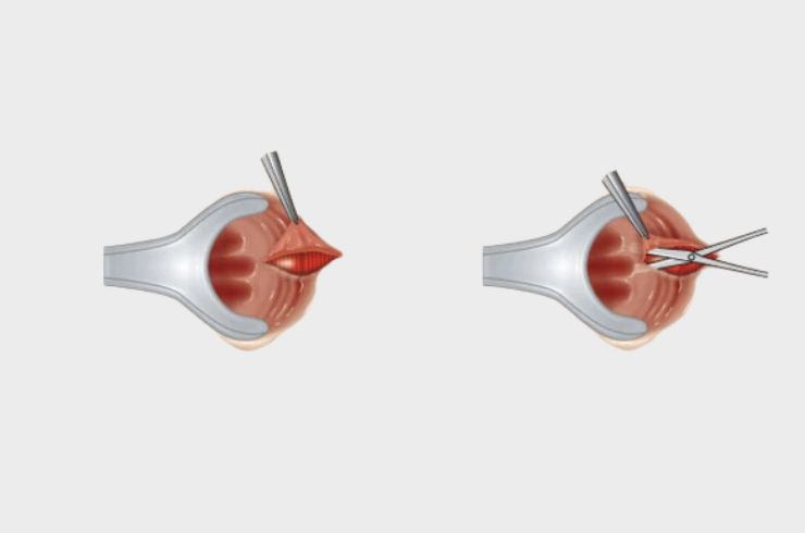 Lateral Internal Sphincterotomy